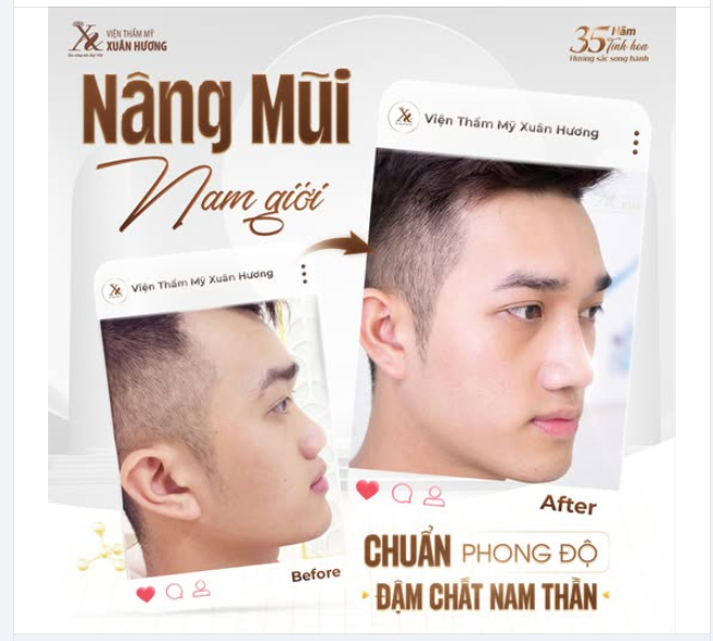 NÂNG MŨI NAM GIỚI – CHUẨN PHONG ĐỘ, ĐẬM CHẤT NAM THẦN