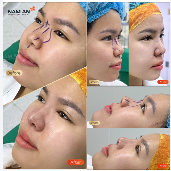 DÁNG MŨI HOÀN HẢO ĐẾN TỪNG GÓC NHÌN