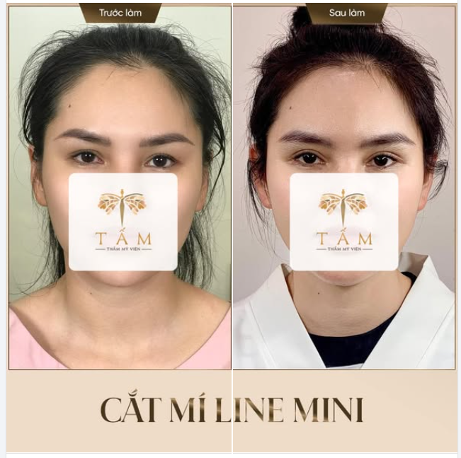 KẾT QUẢ CẮT MÍ LINE MINI SAU 6 THÁNG