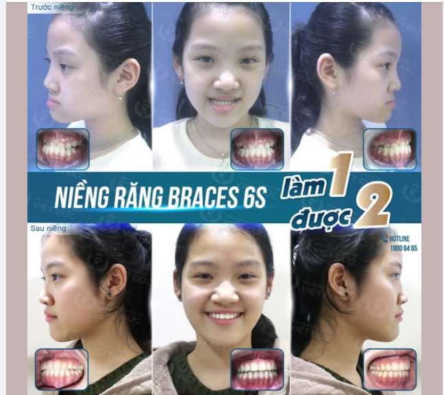 CẢM ƠN BA MẸ ĐÃ CHO CON NIỀNG RĂNG SỚM!!!