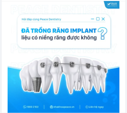 TRỒNG RĂNG IMPLANT CÓ NIỀNG RĂNG ĐƯỢC KHÔNG VÀ GIẢI ĐÁP TỪ PEACE DENTISTRY