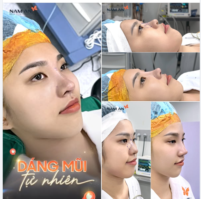 DÁNG MŨI TỰ NHIÊN SAU PHẪU THUẬT