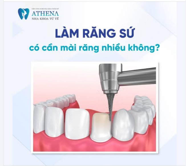 Mài răng khi làm răng sứ là một bước quan trọng trong quá trình thẩm mỹ nha khoa, giúp bọc mão sứ ôm sát và chắc chắn trên răng thật.