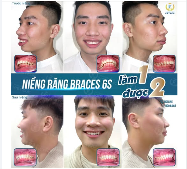 MỪNG NGÀY THÁO NIỀNG: KHÁCH HÀNG NGÔ KIM THÀNH  NIỀNG RĂNG HẾT HÔ, HẾT CƯỜI HỞ LỢI