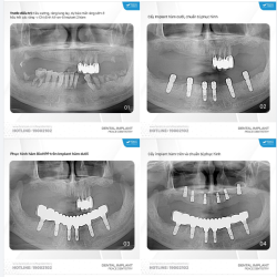 Ca lâm sàng trồng răng Implant tại Peace Dentistry với mục tiêu khôi phục hoàn chỉnh chức năng ăn nhai, nâng cao thẩm mỹ nụ cười toàn diện để khách hàng có một cái Tết thật trọn vẹn và ý nghĩa!