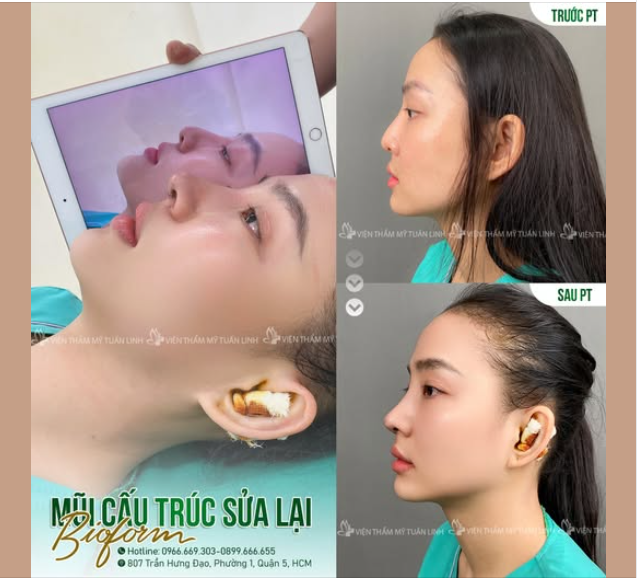 Mũi cấu trúc sửa lại đẹp hài hòa, sắc nét ngay sau phẫu thuật!!