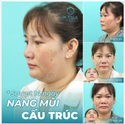 Tâm trạng chung của nhiều người từng nâng mũi tại DR.FACE.