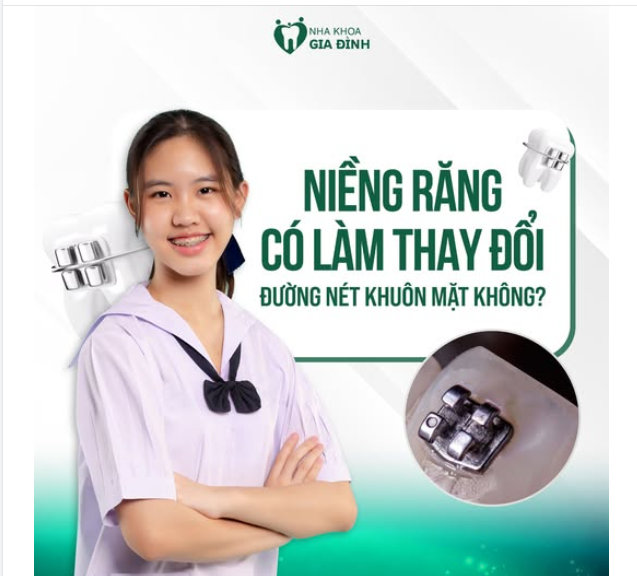 NIỀNG RĂNG CÓ LÀM THAY ĐỔI ĐƯỜNG NÉT KHUÔN MẶT KHÔNG?