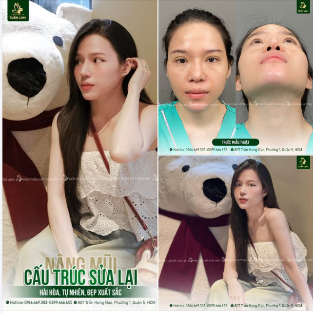 Mũi cũ bị lắc, chạy sóng, lệch, bao xơ nhiều...Và kết quả sau khi sửa lại tại Tuấn Linh Đẹp hài hòa, tự nhiên cực kỳ sắc nét, tôn dáng sang chảnh cho gương mặt.
