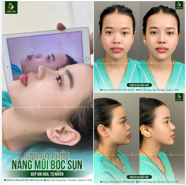 Mũi bọc sụn chỉ 17TR (trọn gói) - Xóa sổ mũi thấp tẹt, lên dáng mũi mới cao thanh tú.