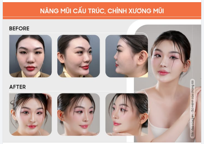 DÁNG MŨI THANH TÚ TẠI NAM AN