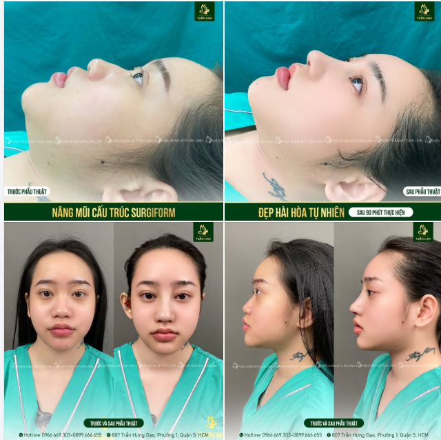 Đừng để chiếc mũi gồ ghề, thấp tẹt '' phong ấn'' nhan sắc và phong thủy của bạn!!