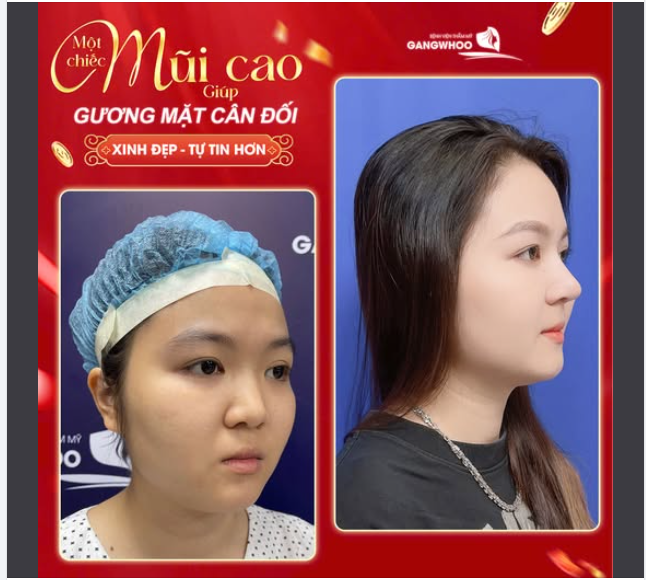 MỘT CHIẾC MŨI CAO GIÚP GƯƠNG MẶT CÂN ĐỐI