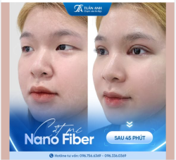 Cắt mí Nano Fiber Độc Quyền tại Dr Tuấn Anh