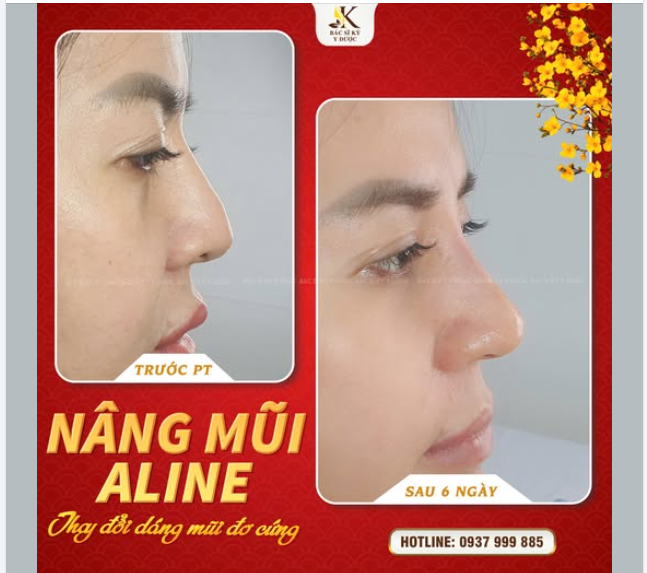 NÂNG MŨI ALINE – TỰ TIN ĐÓN TẾT XINH