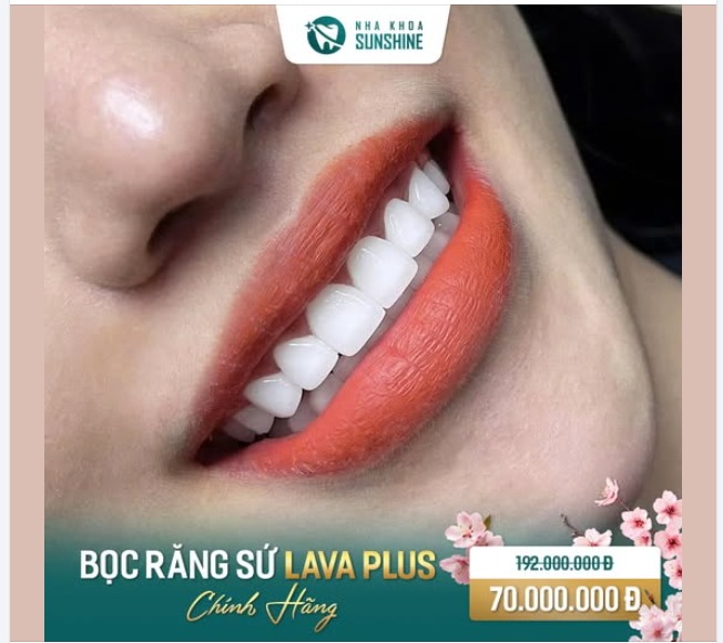 RĂNG SỨ LAVA PLUS - BẢO HÀNH 15 NĂM HAY 30 NĂM?