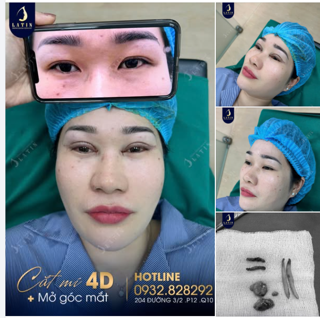 Kết quả Cắt mí 4D + Mở góc mặt cho chị gái đến từ Cà Mau