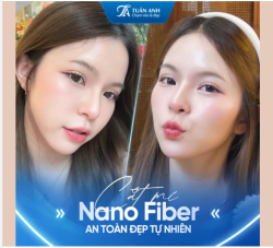 Cắt mí Nano Fiber 7 ngày đẹp tự nhiên - Thời điểm vàng cho nàng cắt mí