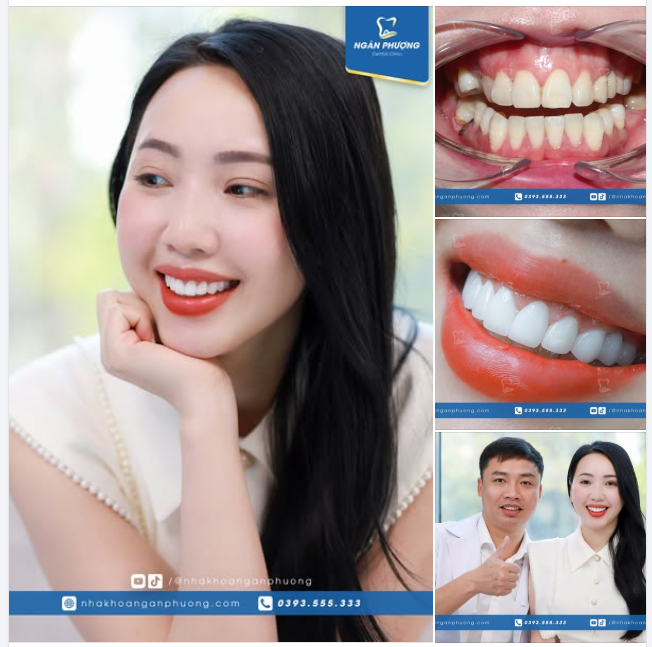 Thay đổi 10 răng hàm trên cho diện mạo vạn người mê