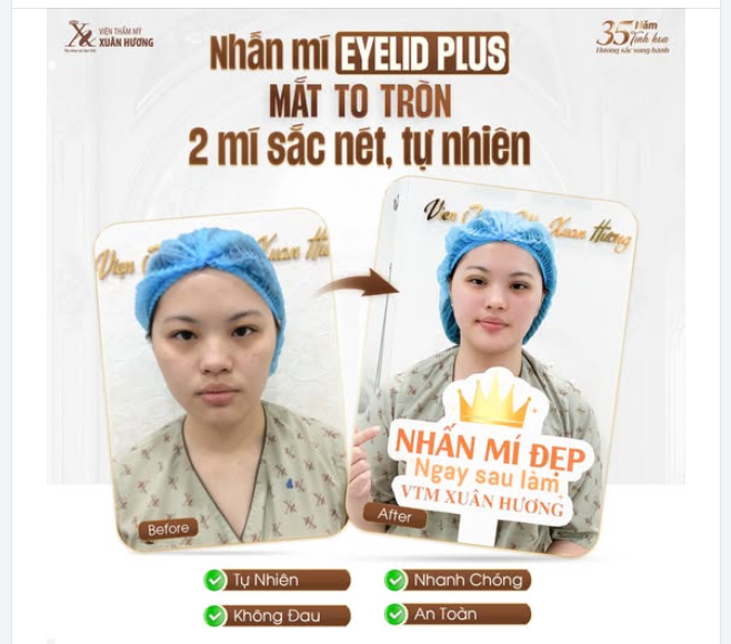 Mắt nhỏ 1 mí khiến bạn tự ti?  Với phương pháp nhấn mí EYELID PLUS