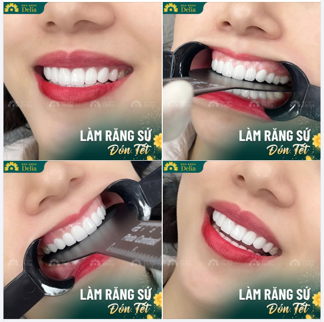 LÀM RĂNG KỊP TẾT CHỈ VỚI 48 GIỜ TẠI DELIA