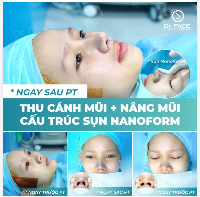 MŨI ĐẸP ĐÂY, MŨI ĐẸP ĐÂY…