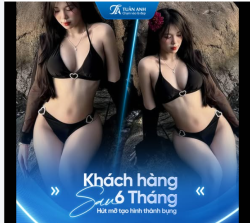 Mời cả nhà cùng chiêm ngưỡng hình ảnh khách hàng sau 6 tháng thực hiện dịch vụ hút mỡ  tạo hình thành bụng tại Dr Tuấn Anh