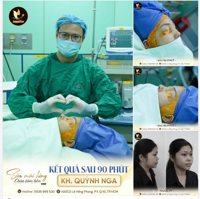 KẾT QUẢ NÂNG MŨI SỤN SƯỜN  TÌM LẠI TỰ TIN QUỲNH NGA - CHỦ NHÂN SUẤT TÀI TRỢ 100% SỬA MŨI HỎNG