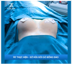 90' THỰC HIỆN NÂNG NGỰC TẠI DR TUẤN ANH SỞ HỮU NGAY: