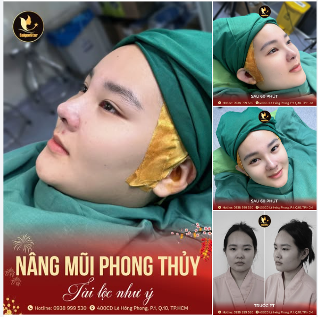 60 PHÚT NÂNG MŨI CẤU TRÚC – THAY DIỆN MẠO ĐỔI PHONG THỦY