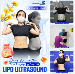 KẾT QUẢ SAU 7 NGÀY GIẢM MỠ CÔNG NGHỆ LIPO ULTRASOUND