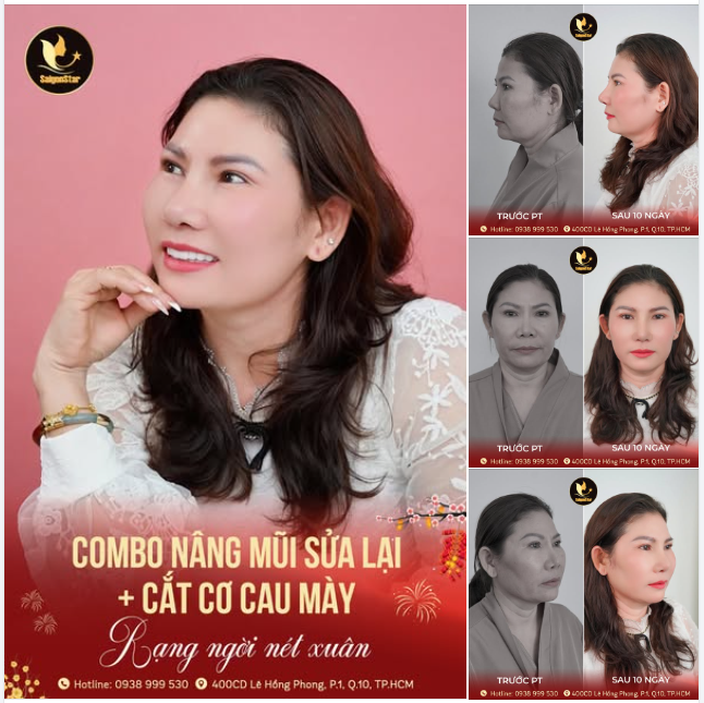 KHÁCH HÀNG U60 KHOE SẮC XUÂN RẠNG NGỜI  SAU 10 NGÀY NÂNG MŨI SỬA LẠI + CẮT CƠ CAU MÀY