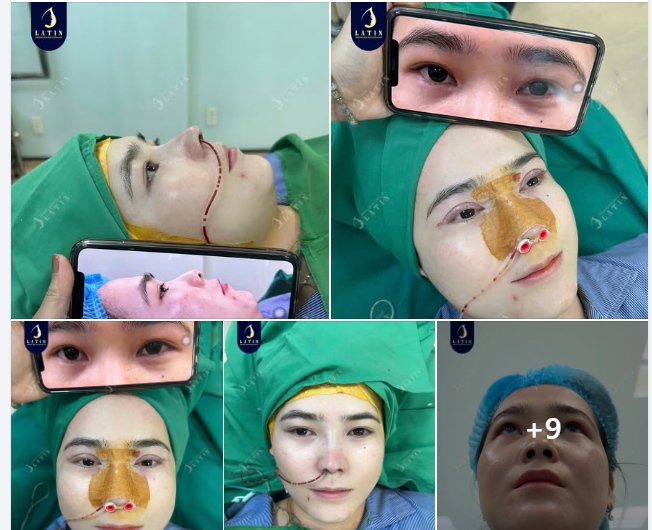 Combo Nâng mũi + Cắt mí cho chị gái đến từ Bình Dương