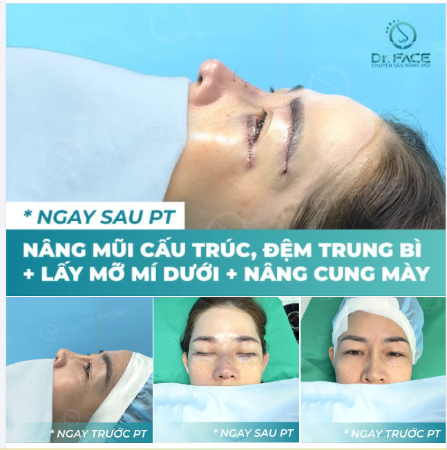 Combo ĐẸP TOÀN DIỆN cả MẮT VÀ MŨI
