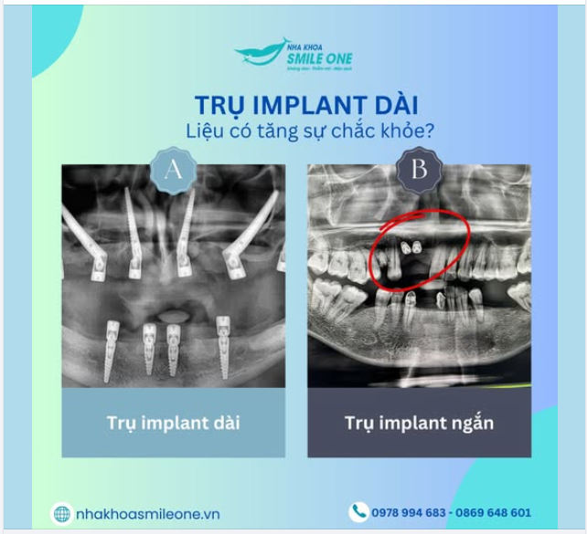 TRỤ IMPLANT DÀI, LIỆU CÓ TĂNG SỰ CHẮC KHỎE?