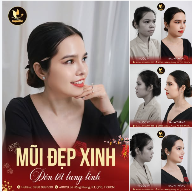 NÂNG MŨI ĐẸP XINH – ĐÓN TẾT LUNG LINH  GIẢM 50% LÌ XÌ KHỦNG ĐẾN 20 TRIỆU