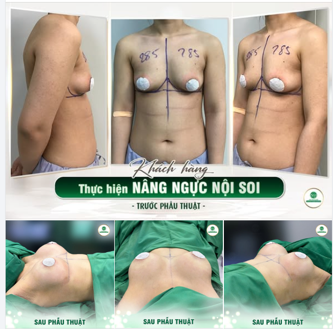 “BIẾT ĐẸP NHƯ NÀY CHỊ SẼ NÂNG NGỰC SỚM HƠN”