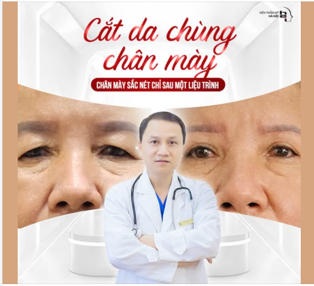 Cắt da chùng chân mày KHÔNG KHÂU DA Đôi mắt lấy lại vẻ đẹp khoẻ mạnh