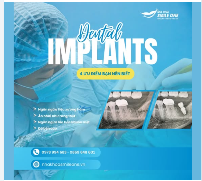 4 ƯU ĐIỂM VƯỢT TRỘI CỦA CẤY GHÉP IMPLANT BẠN NÊN BIẾT!