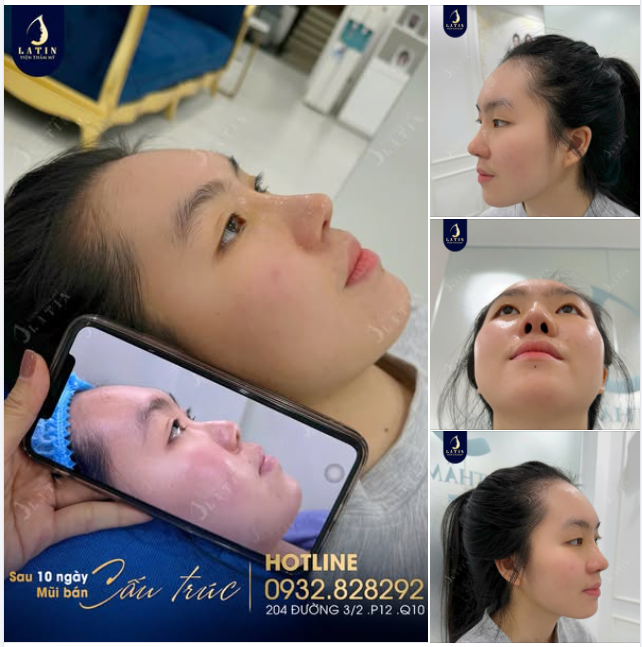 Mũi bán cấu trúc sụn tai 10 ngày lên dáng tự nhiên cho em gái