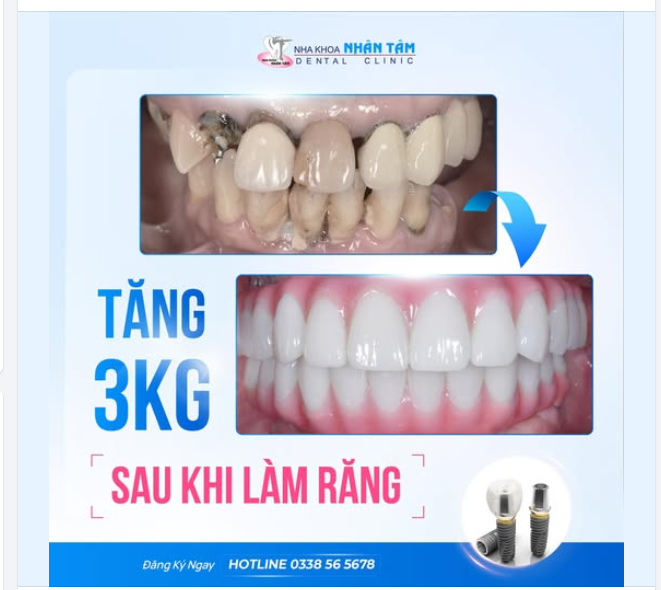 Ai nói răng đã hư là không thể cứu vãn? Cô N.T. Lan, 59 tuổi, đã từng nghĩ như vậy. Hàng chục năm sống chung với hàm răng bị hư, cô luôn e ngại mỗi khi đến giờ ăn vì đau nhức.