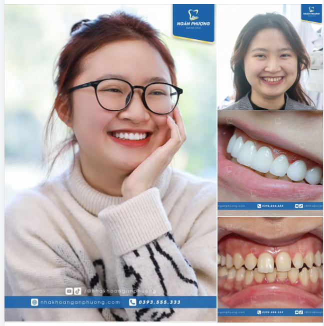 Lại là một chị đẹp chỉ làm hàm trên đã có nụ cười 1000 điểm