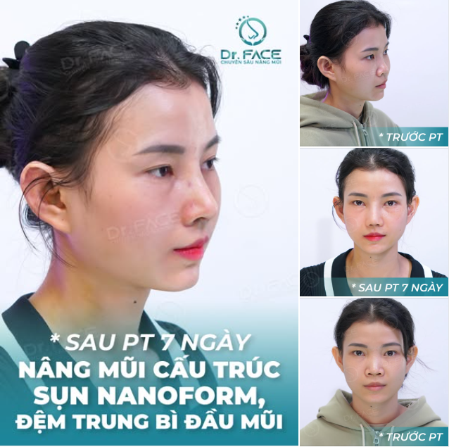 Ai như em không BA MẸ “XÚI” ĐI NÂNG MŨI