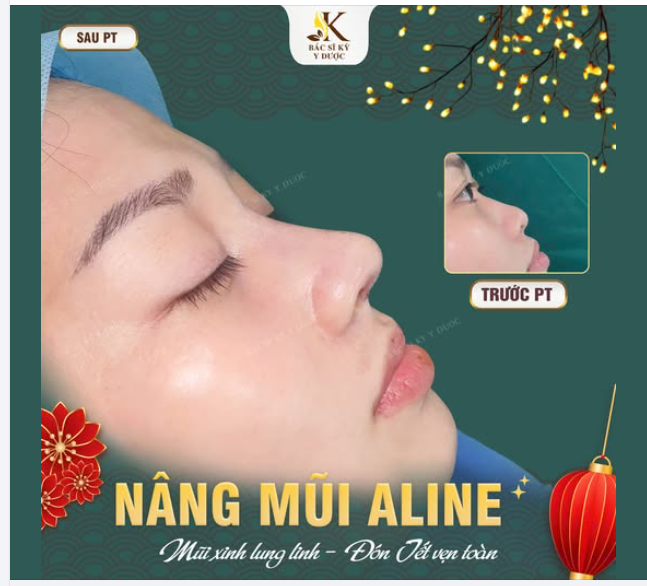 NÂNG MŨI ALINE  Mũi xinh lung linh - Đón Tết vẹn toàn