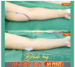 ĐÁNH BAY BẮP TAY "KÉM DUYÊN" CHỈ TRONG 60 PHÚT!