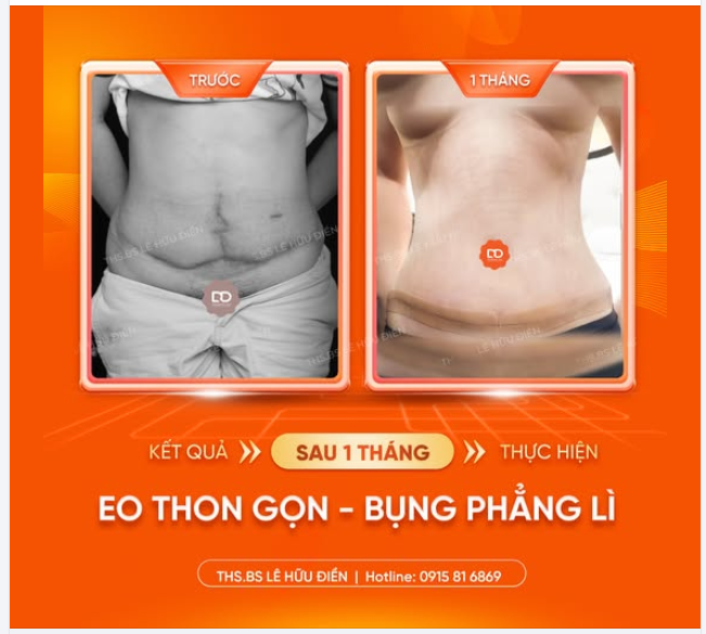 BỤNG KHÔNG TO NHƯNG MẤT TỰ TIN VÌ SẸO XẤU.