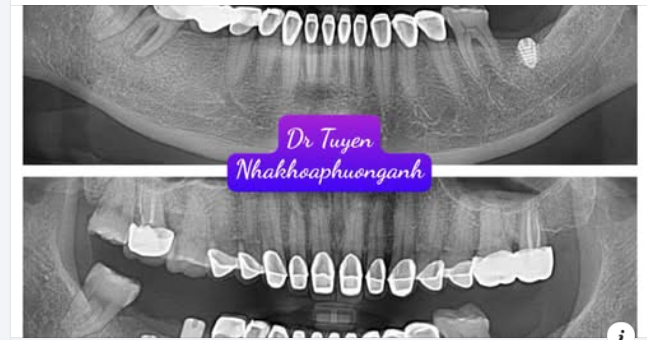 Hướng dẫn chăm sóc răng sau cấy implant