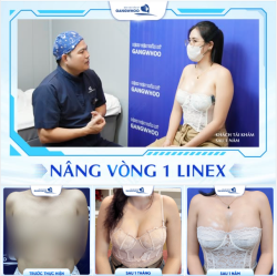 NÂNG VÒNG 1 LINEX - KẾT QUẢ SAU 1 NĂM