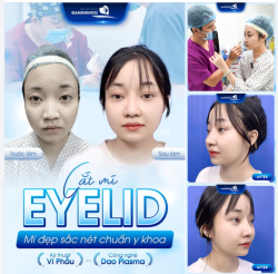 MÍ NÉT CHÀO XUÂN ẤT TỴ VỚI CẮT MÍ EYELID