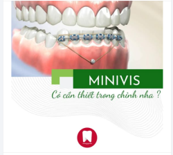 MINIVIS CÓ CẦN THIẾT KHI CHỈNH NHA?